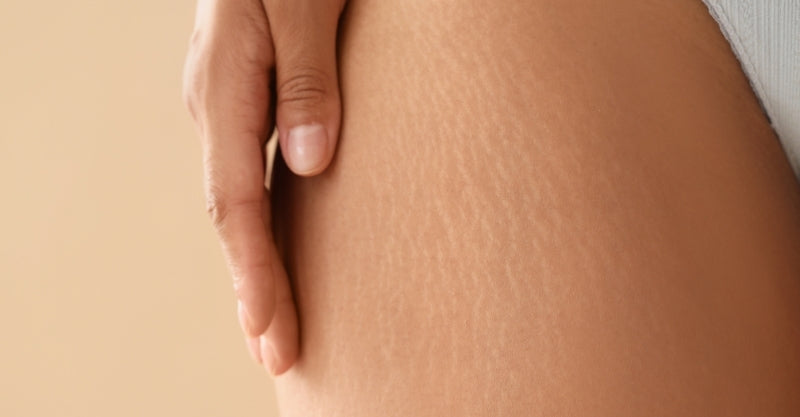 Cellulite Is Not Only a Fat Issue — It’s Also a Skin Issue