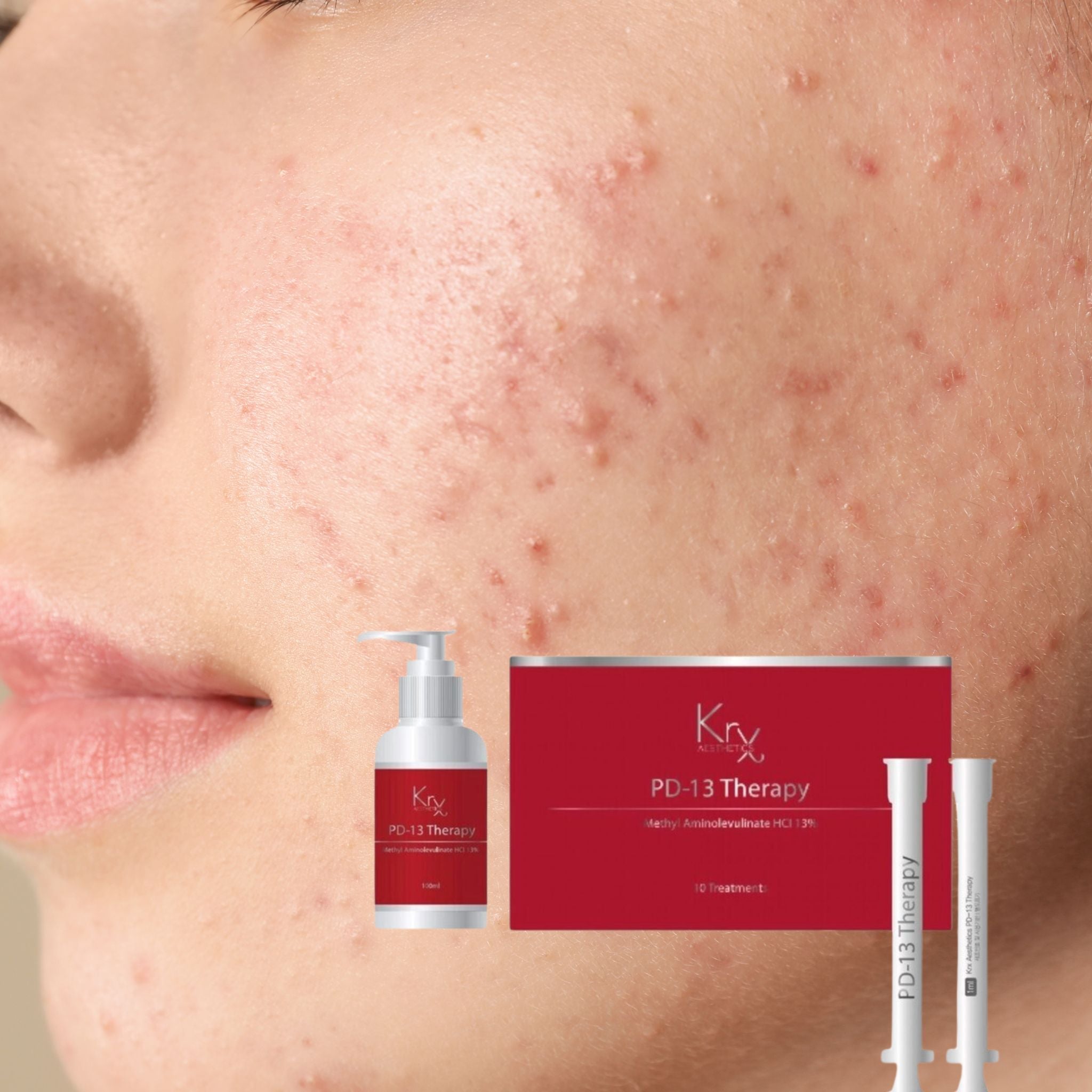 PD13 Therapy (Acne)